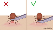Entfernung von Zecken