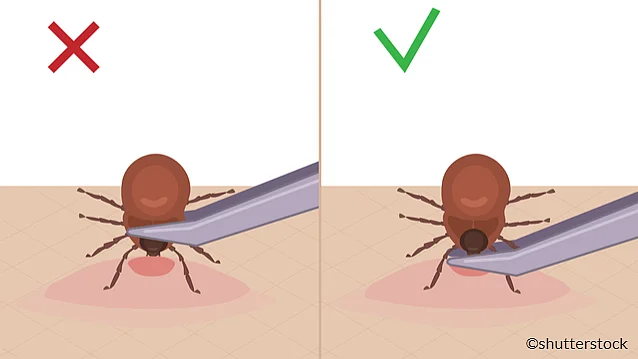 Entfernung von Zecken
